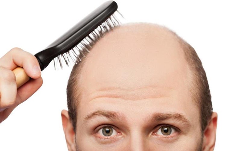 هفت مرحله از طاس شدن موی آقایان