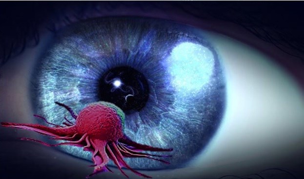 تشخیص و درمان تومورهای چشمی