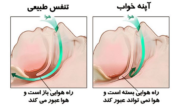 بررسی چیستی آپنه خواب و روش های درمان آن