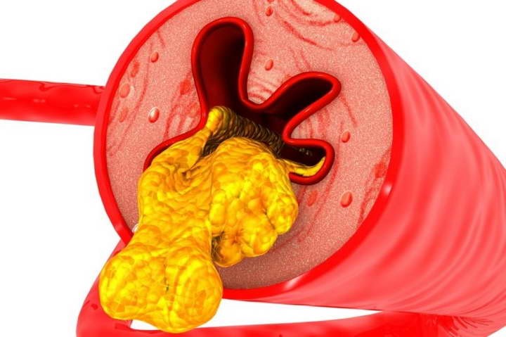 چربی سوزی در افراد چاق و سریعترین شیوه آن